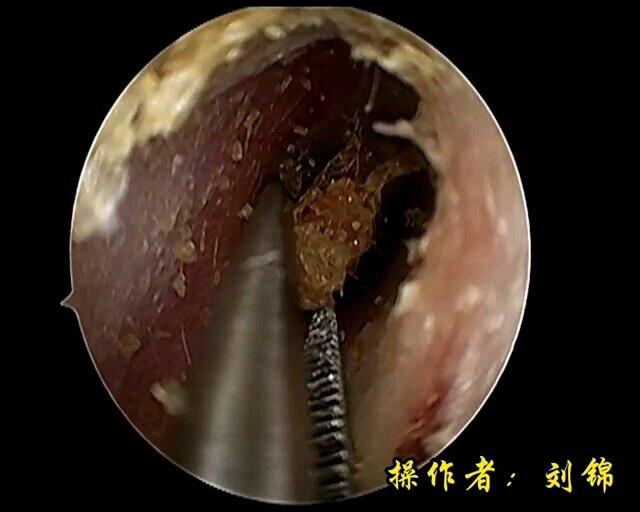 耵聍最新研究进展与应用概述