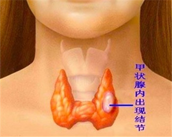 甲状腺领域最新研究进展揭秘